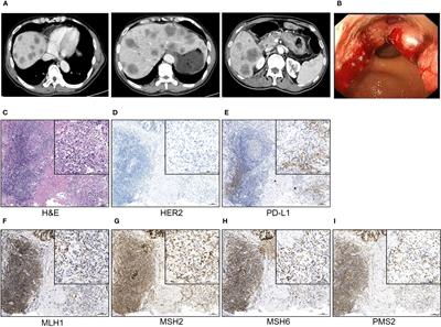 Case Report: A rare case of recurrent ascites after anti-Claudin18.2 antibody therapy for metastatic gastric cancer while responding sustainingly
